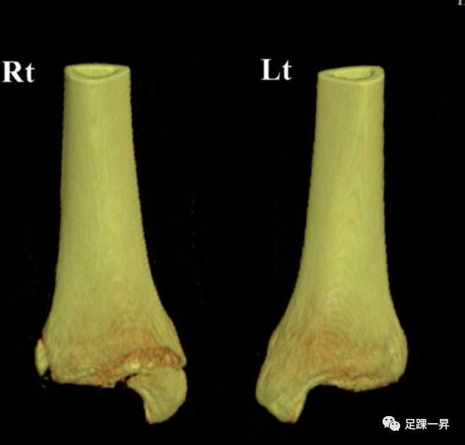 Application of 3D Printing Technology in Complex Tibial Fractures