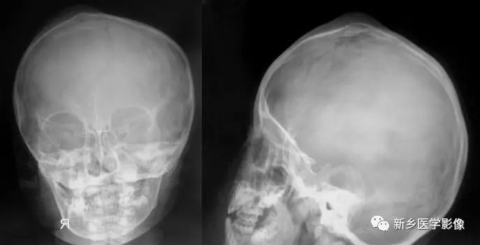 Overview of Proteus Syndrome