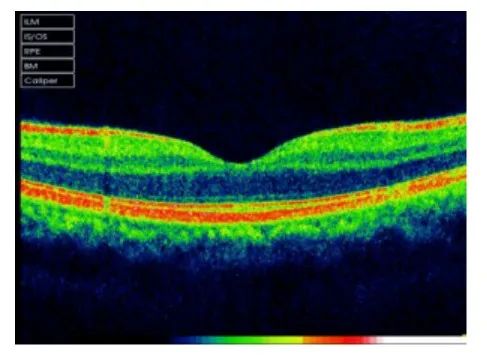 How to Identify Macular Edema in OCT Examination