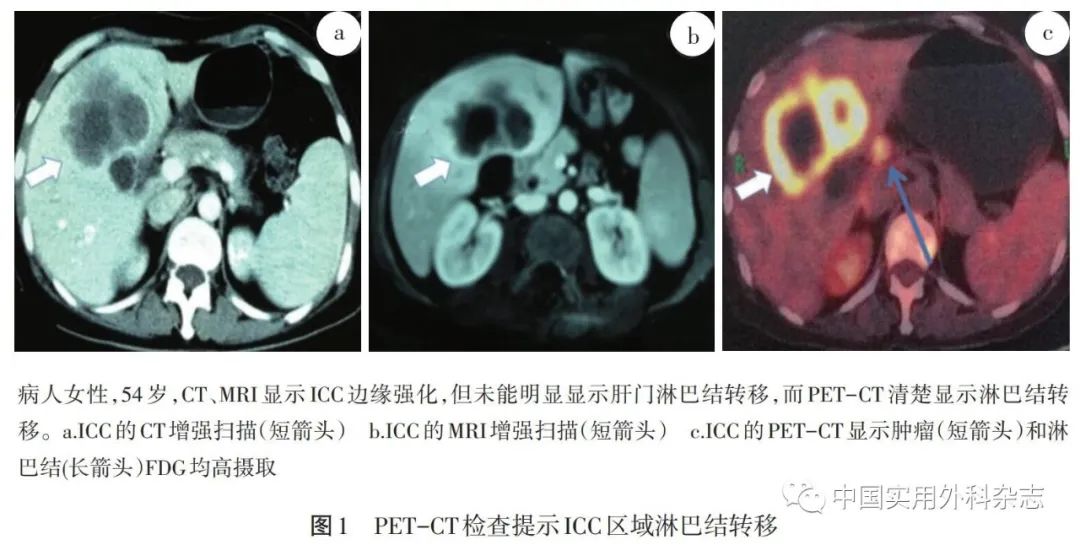 Imaging Diagnosis of Intrahepatic Cholangiocarcinoma