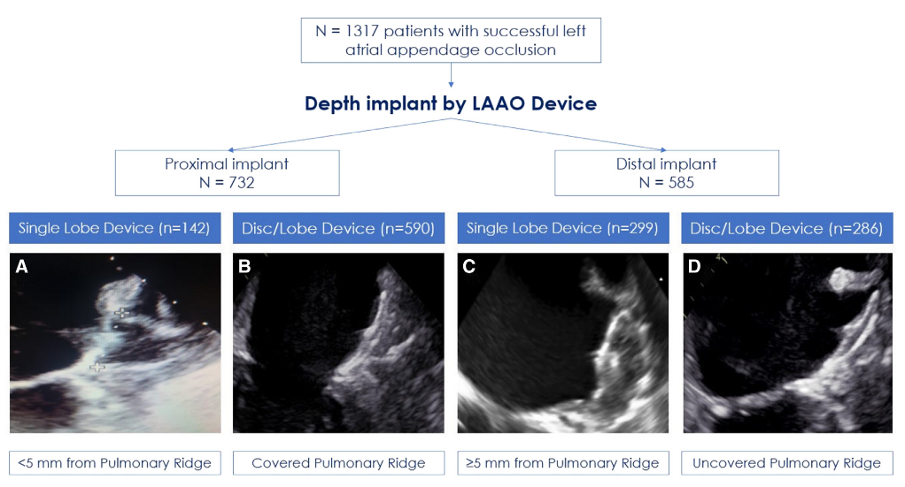 Impact of Left Atrial Appendage Occlusion Device Implant Depth on Thrombus Formation