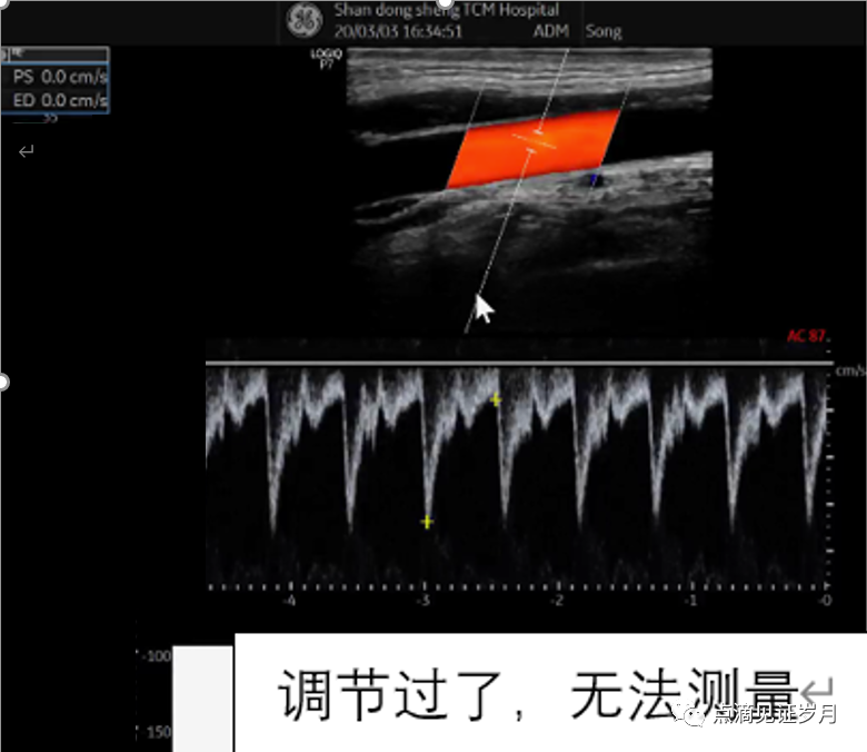 Understanding and Adjusting Parameters of Color Doppler Ultrasound Machines