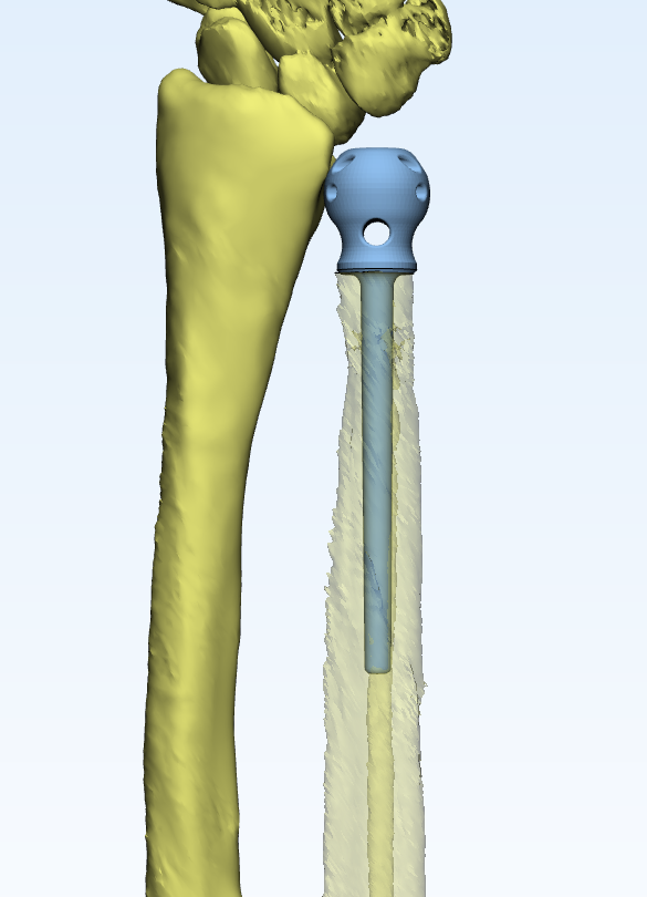Can 3D Printed Bones Replace Original Ones?