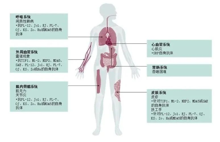Clinical Significance of Myositis Antibody Spectrum Detection