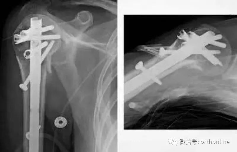 Introduction and Resetting Tips for Proximal Humerus Multilock Intramedullary Nail