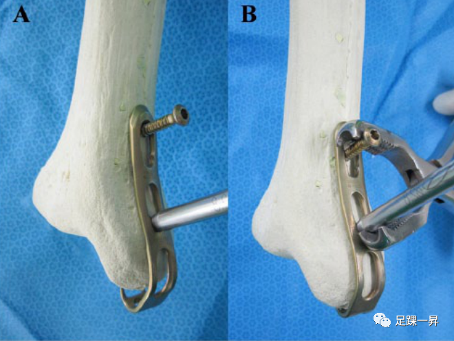 Application of 3D Printing Technology in Complex Tibial Fractures