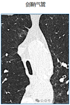 Compilation of Chest Imaging Terminology (IV)