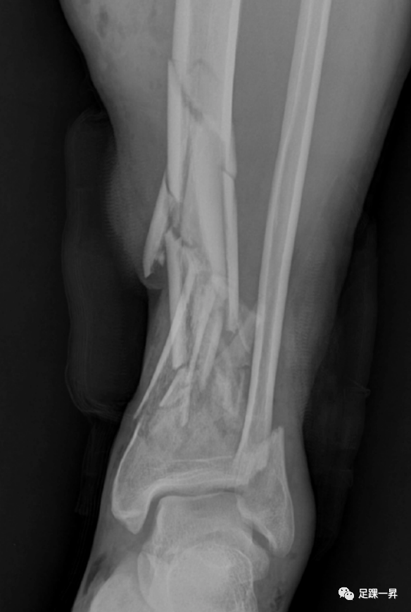 Application of 3D Printing Technology in Complex Tibial Fractures