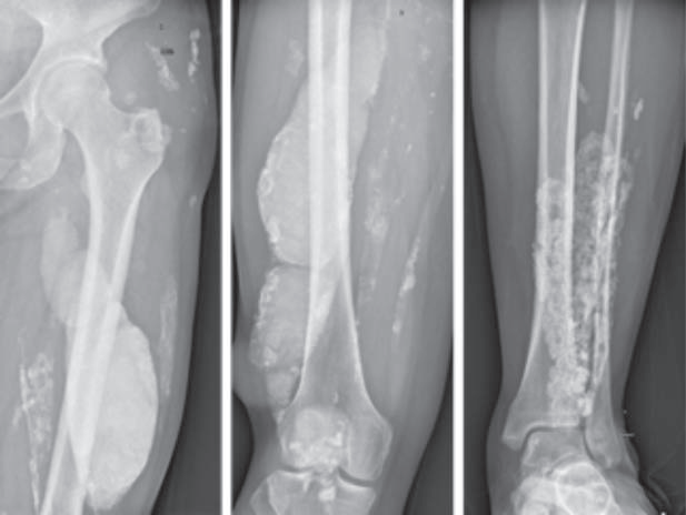 Understanding NXP2 Positive Juvenile Dermatomyositis