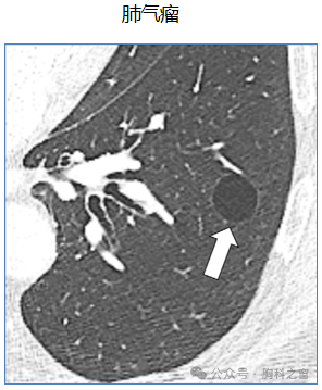 Compilation of Chest Imaging Terminology (IV)