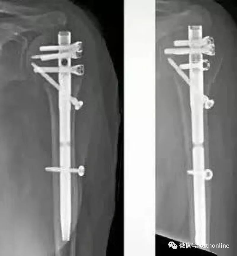 Introduction and Resetting Tips for Proximal Humerus Multilock Intramedullary Nail