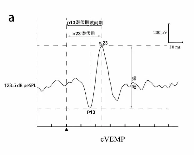 Clinical Practice Consensus on Vestibular Evoked Myogenic Potentials in China (2024)
