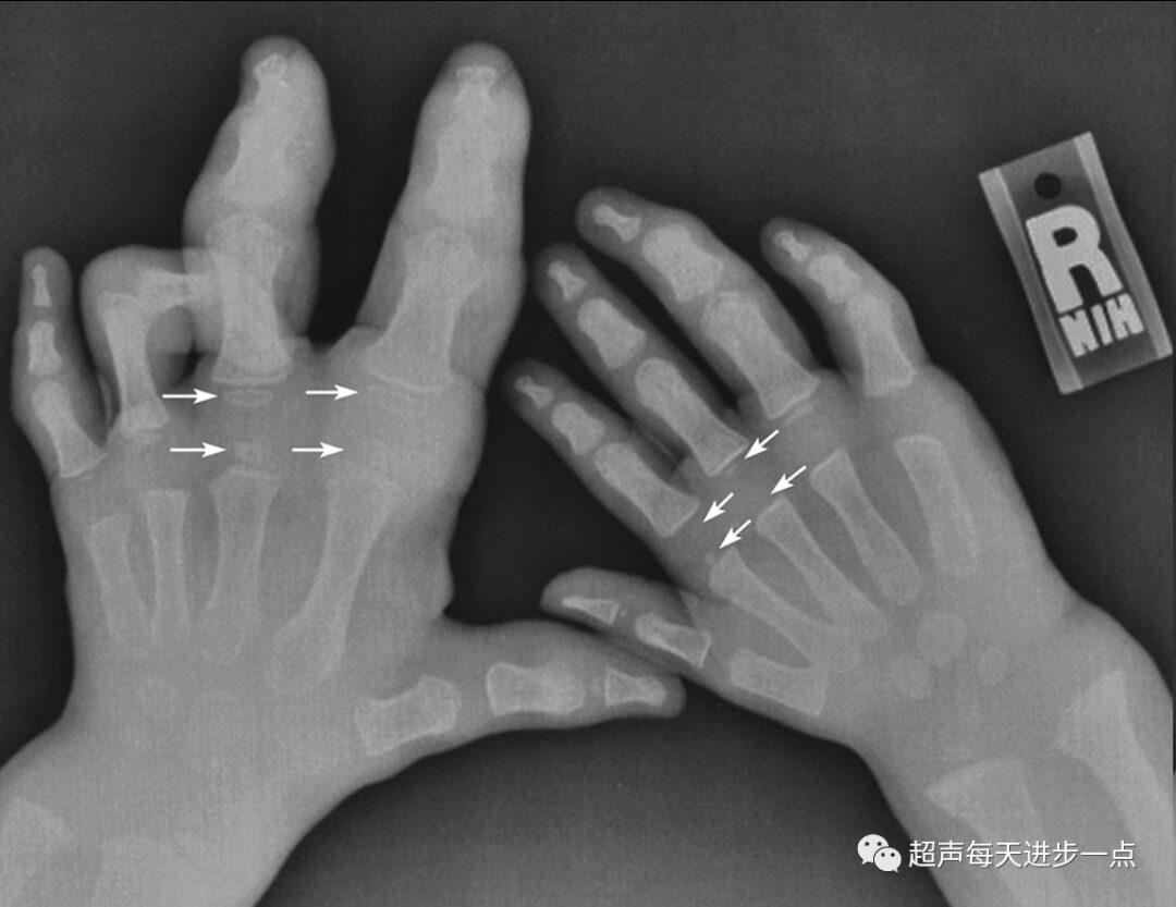Proteus Syndrome: Characteristics and Diagnosis
