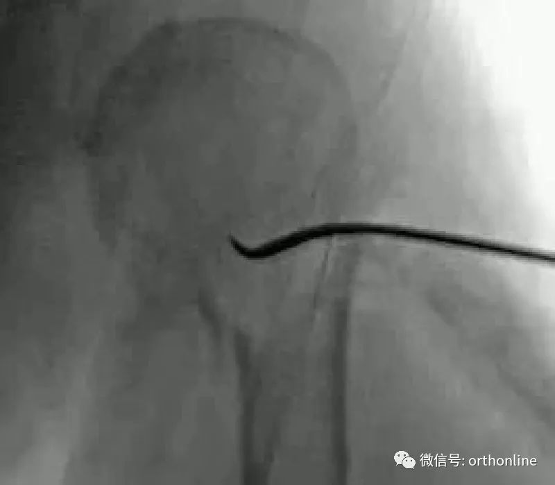 Introduction and Resetting Tips for Proximal Humerus Multilock Intramedullary Nail