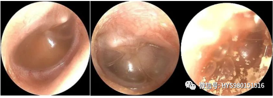 The Past And Present Of Secretory Otitis Media In Children