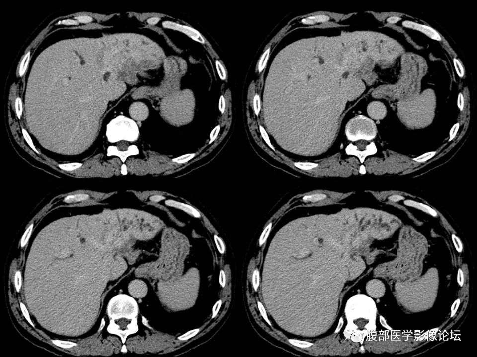 Cholangiocarcinoma: Insights and Clinical Perspectives