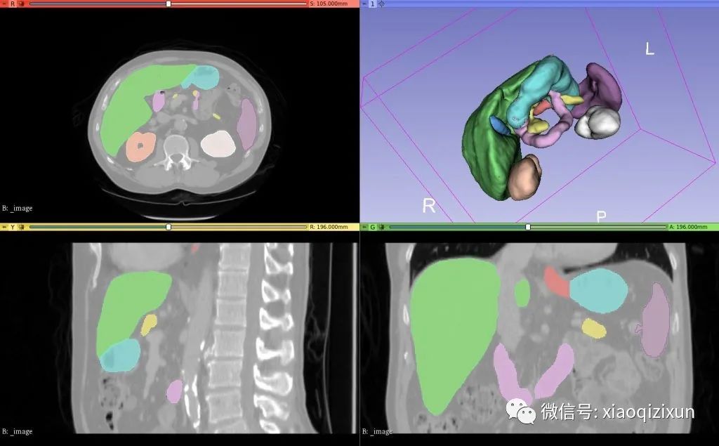 AI-Assisted Segmentation in Medical Imaging: Practical Steps and Case Studies