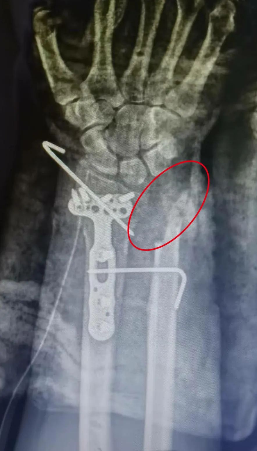 Can 3D Printed Bones Replace Original Ones?
