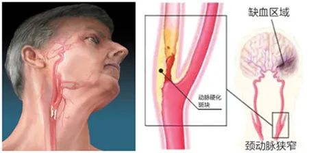 Mastering Clinical Treatment of Internal Carotid Artery Occlusion (ICAO)