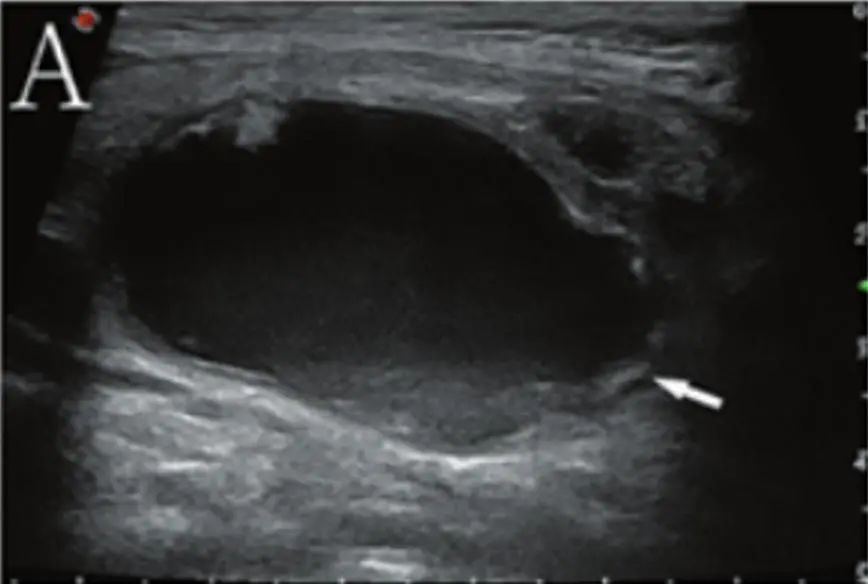 Which Thyroid Nodules Require Surgical Removal? Exploring C-TIRADS Classification