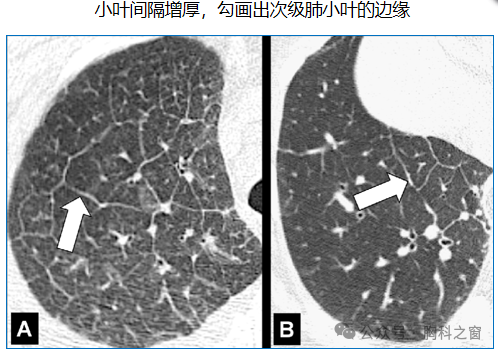 Compilation of Chest Imaging Terminology (IV)