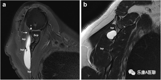 What We Should Know About the Infraspinatus Muscle