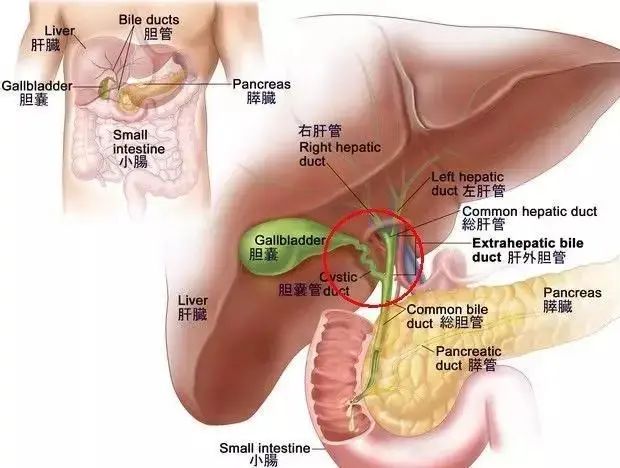 Comprehensive Surgical Treatment of Intrahepatic Cholangiocarcinoma