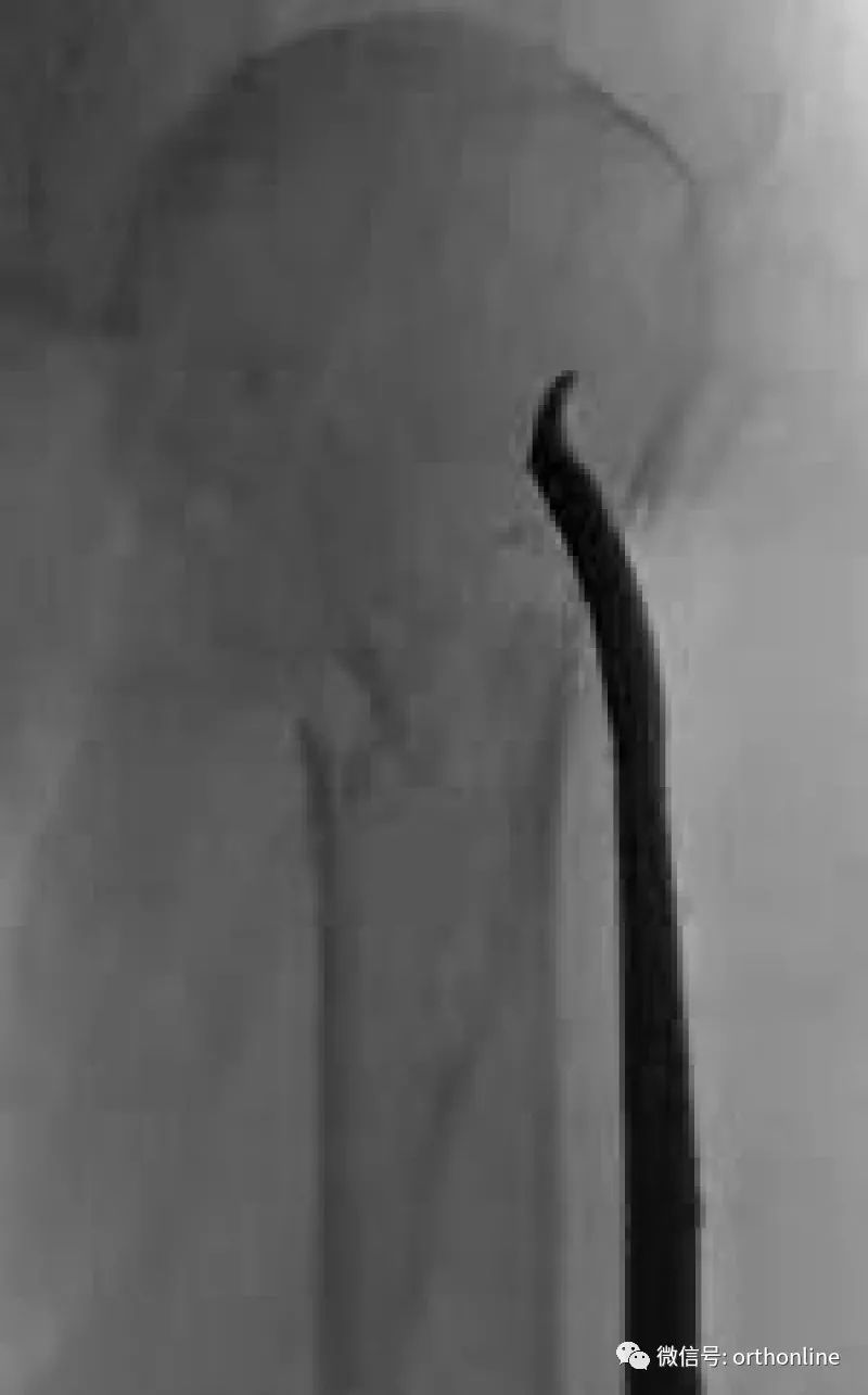 Introduction and Resetting Tips for Proximal Humerus Multilock Intramedullary Nail