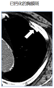 Compilation of Chest Imaging Terminology (IV)