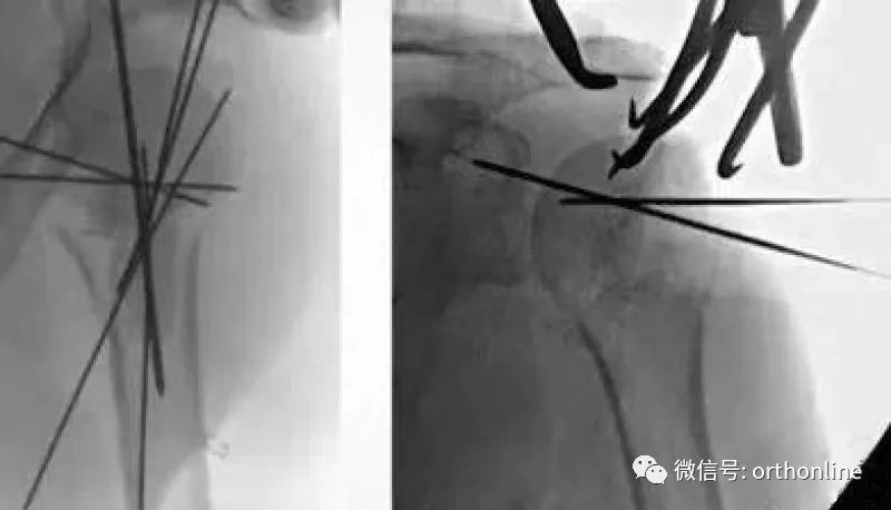 Introduction and Resetting Tips for Proximal Humerus Multilock Intramedullary Nail