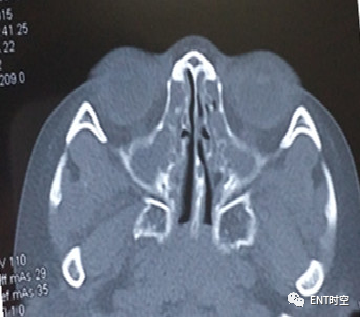Diagnosis and Treatment of Adenoid Hypertrophy and Complications