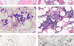 Classification of ICC Pediatric Refractory Cytopenia and MDS