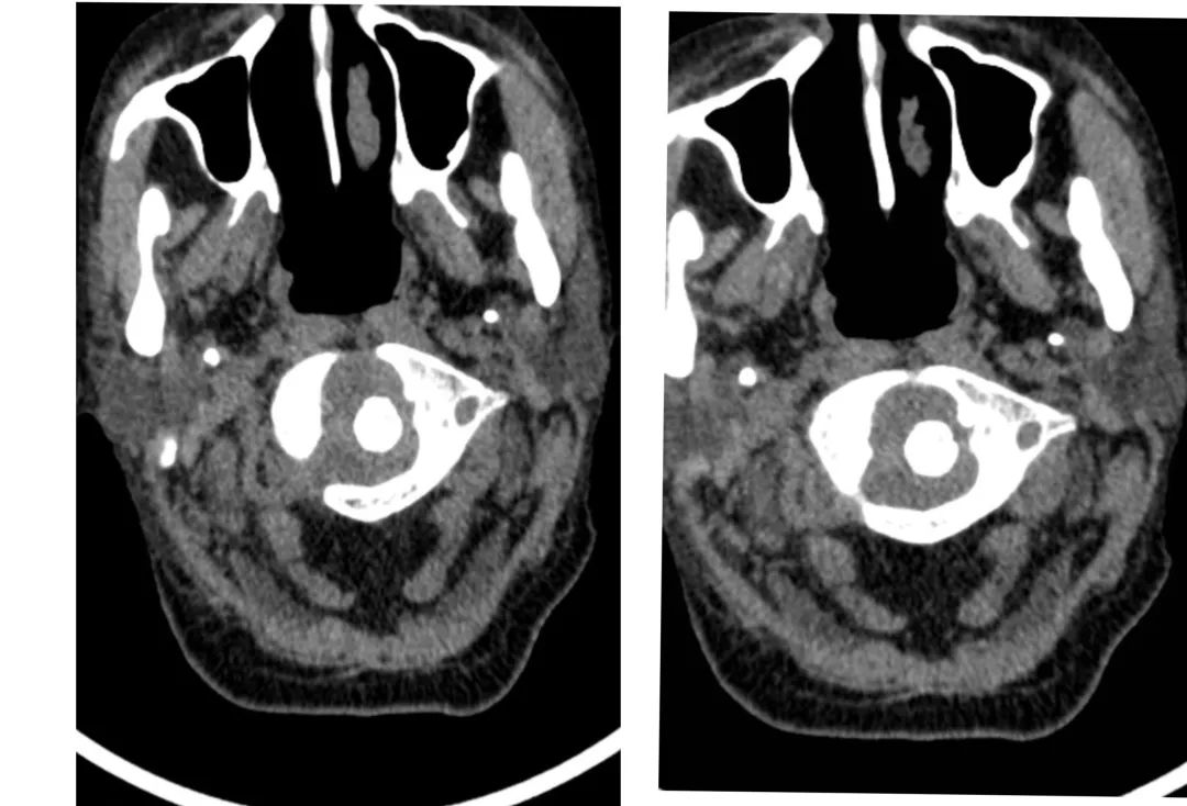3D Printing Bones: Turning Virtual into Reality