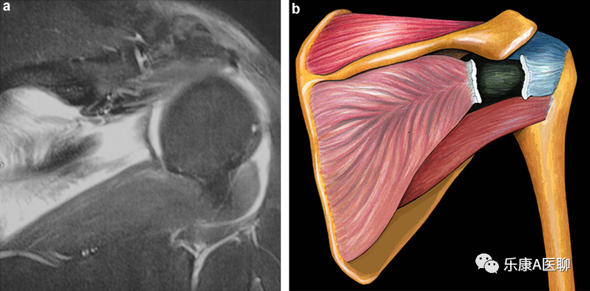 What We Should Know About the Infraspinatus Muscle