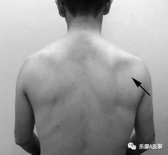 What We Should Know About the Infraspinatus Muscle
