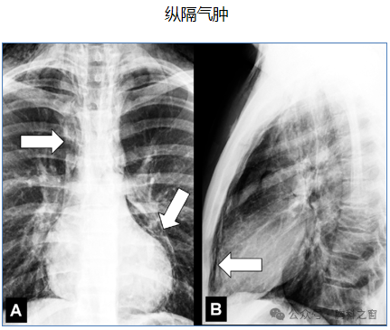 Compilation of Chest Imaging Terminology (IV)