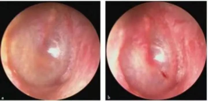 The Past And Present Of Secretory Otitis Media In Children