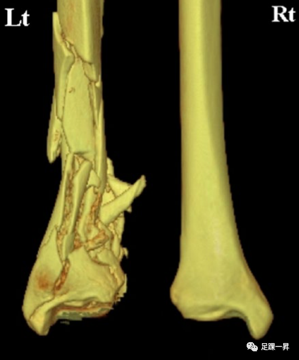 Application of 3D Printing Technology in Complex Tibial Fractures