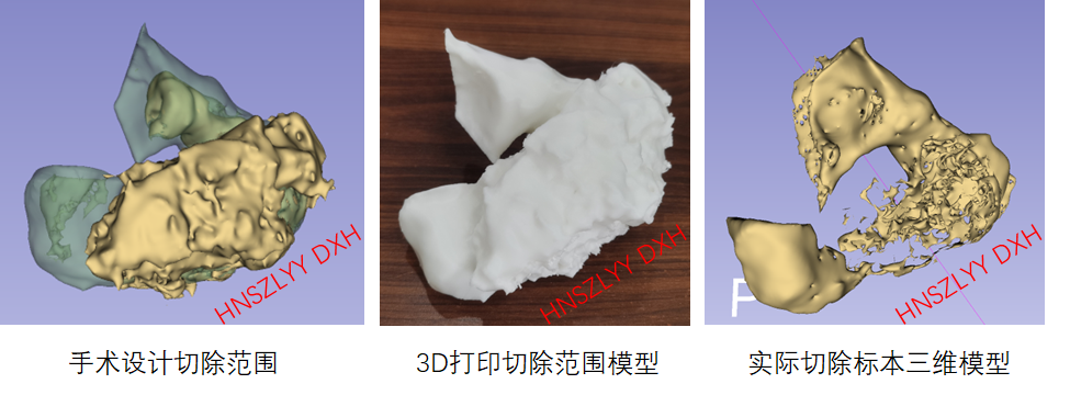 AI and Medical Imaging Fusion Modeling with 3D Printing for Precise Bone Tumor Resection