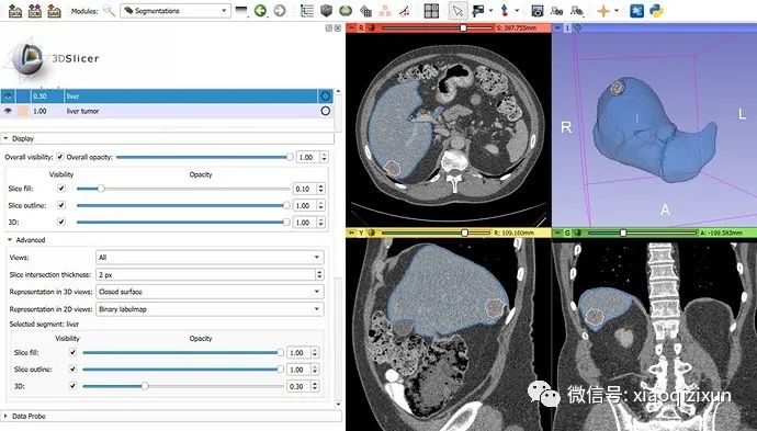 AI-Assisted Segmentation in Medical Imaging: Practical Steps and Case Studies