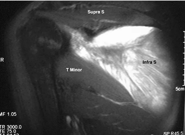 What We Should Know About the Infraspinatus Muscle