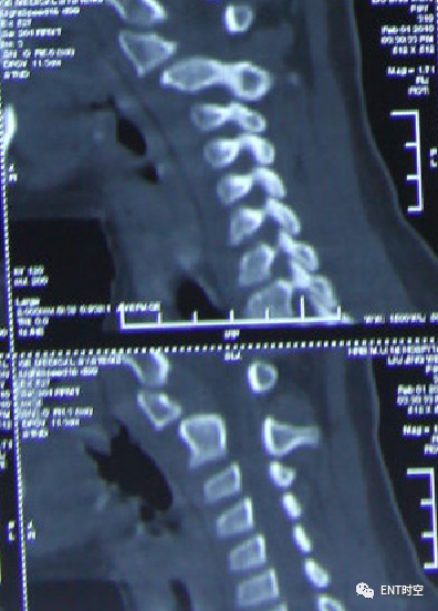 Diagnosis and Treatment of Adenoid Hypertrophy and Complications