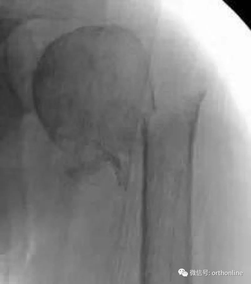 Introduction and Resetting Tips for Proximal Humerus Multilock Intramedullary Nail