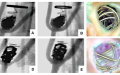 Using Other Stones to Polish Jade: Insights on LAAC Residual Leak Management