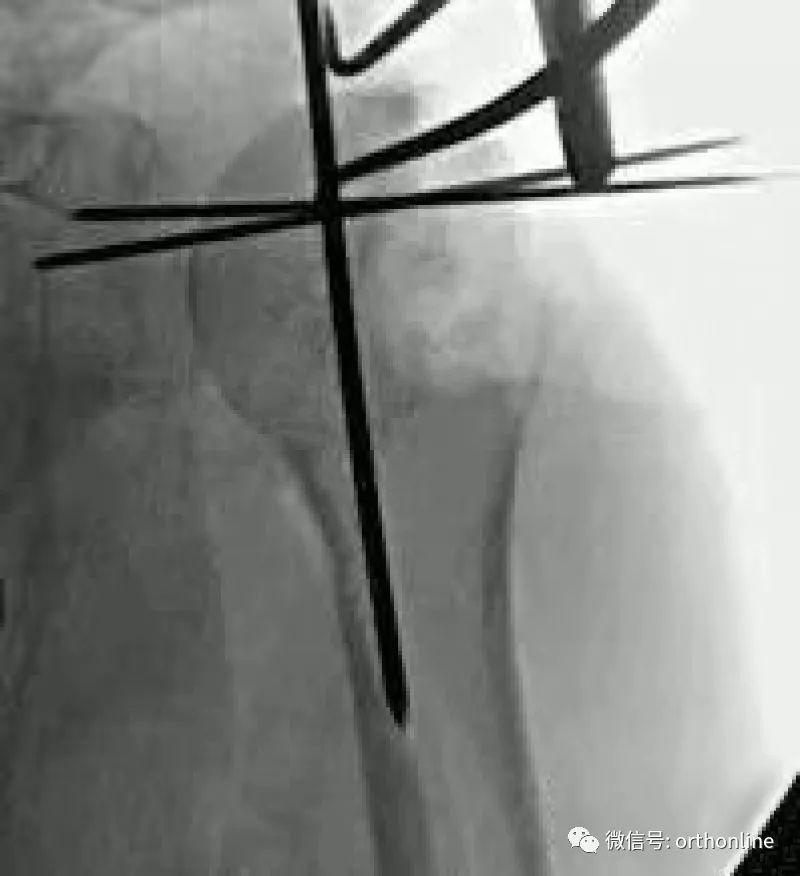 Introduction and Resetting Tips for Proximal Humerus Multilock Intramedullary Nail
