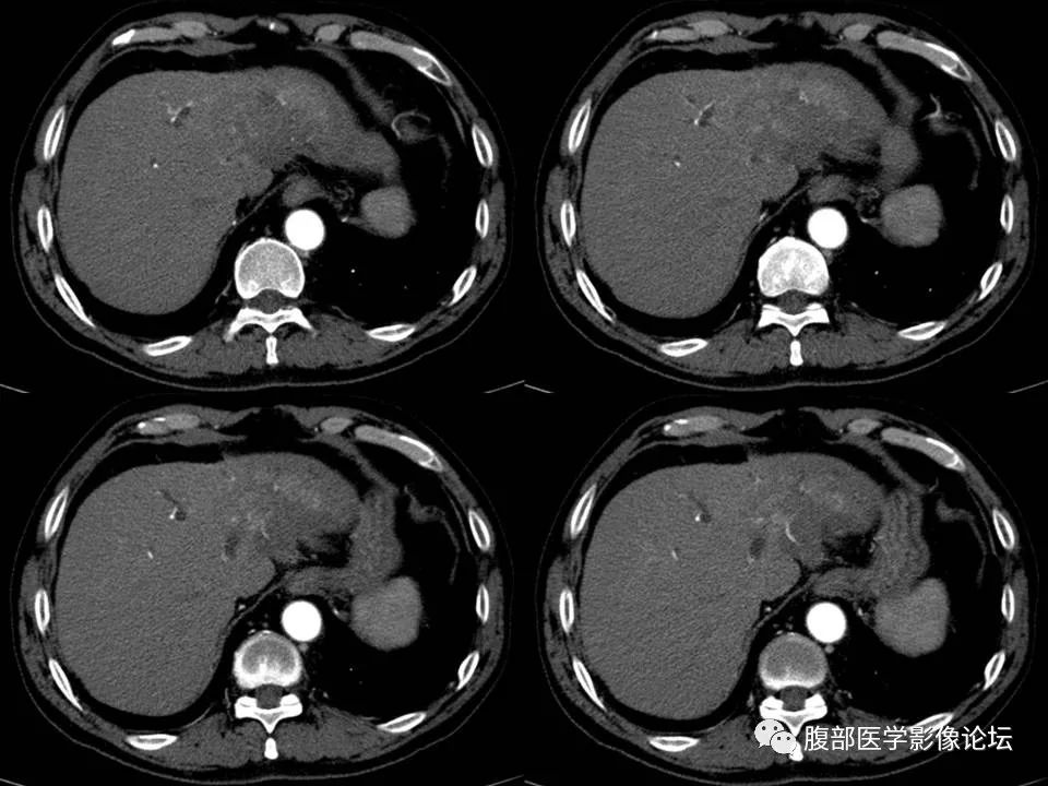 Cholangiocarcinoma: Insights and Clinical Perspectives