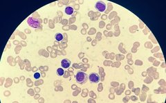 Differences in Classification of TP53-MDS, MDS/AML, and AML by WHO and ICC