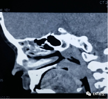 Diagnosis and Treatment of Adenoid Hypertrophy and Complications