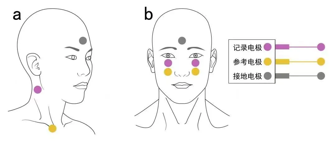 Clinical Practice Consensus on Vestibular Evoked Myogenic Potentials in China (2024)
