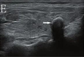 Which Thyroid Nodules Require Surgical Removal? Exploring C-TIRADS Classification